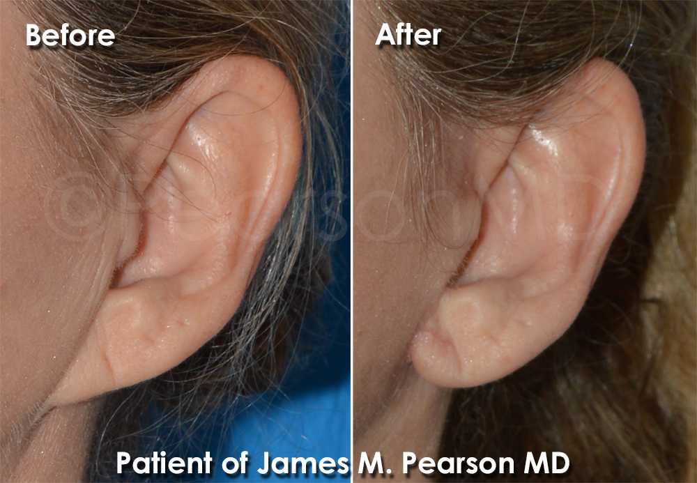 Photo Pearson Pixie Ear Surgery