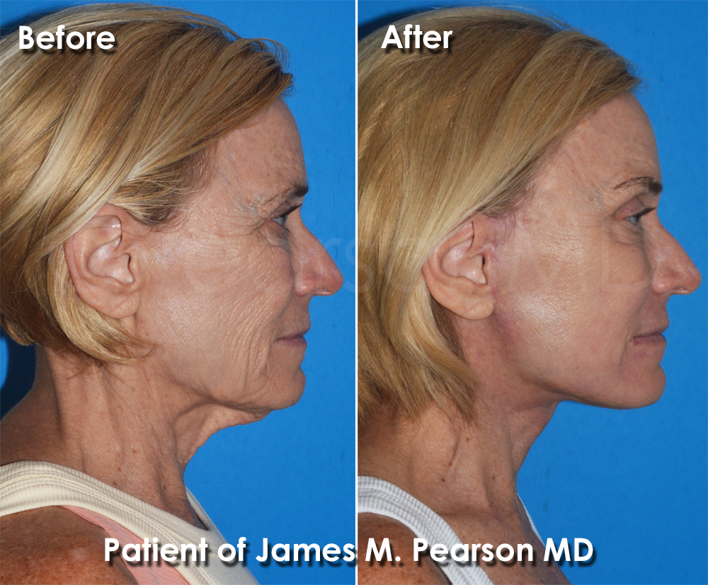 Pearson Plastic Surgery