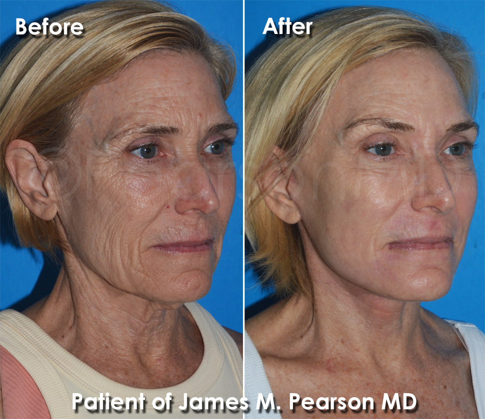Pearson Plastic Surgery
