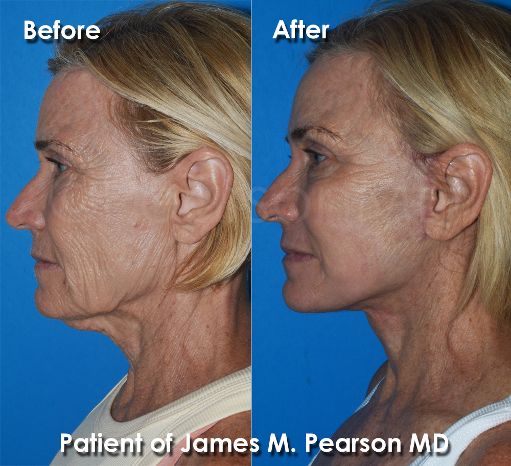 Facelift Dr. Pearson Plastic Surgery