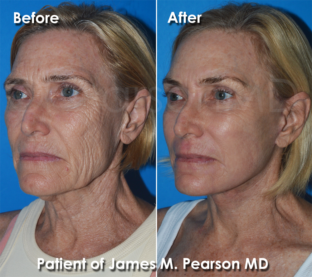 Pearson Plastic Surgery