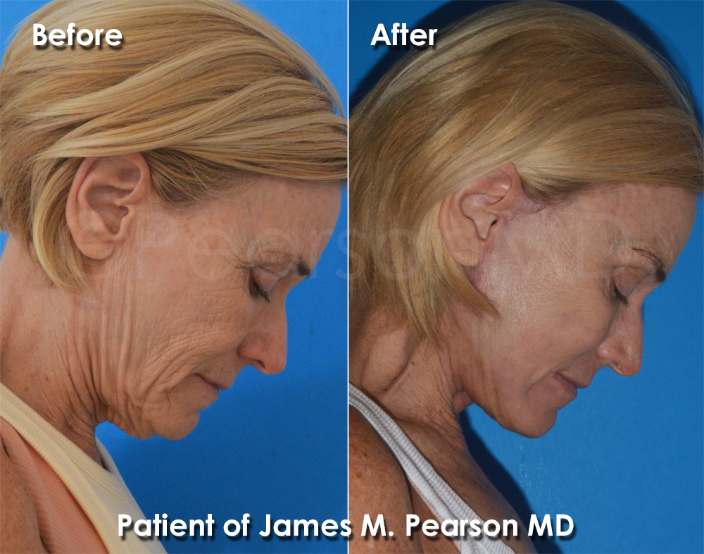 Facelift Dr. Pearson Plastic Surgery