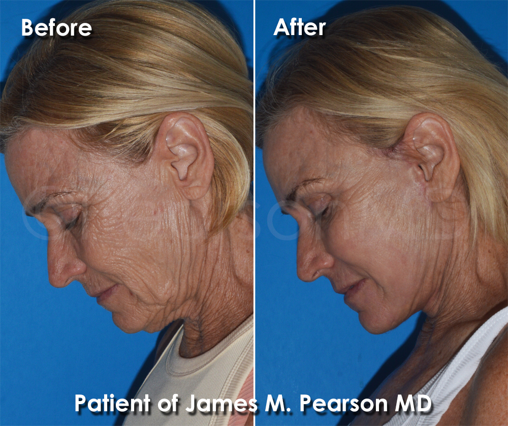 Pearson Plastic Surgery
