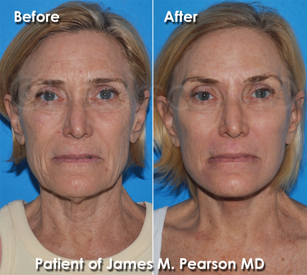 Facelift Dr. Pearson Plastic Surgery