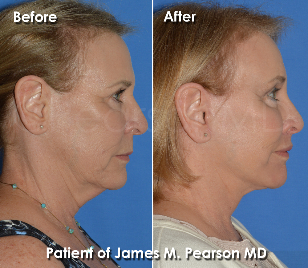 Pearson Facial Rejuvenation