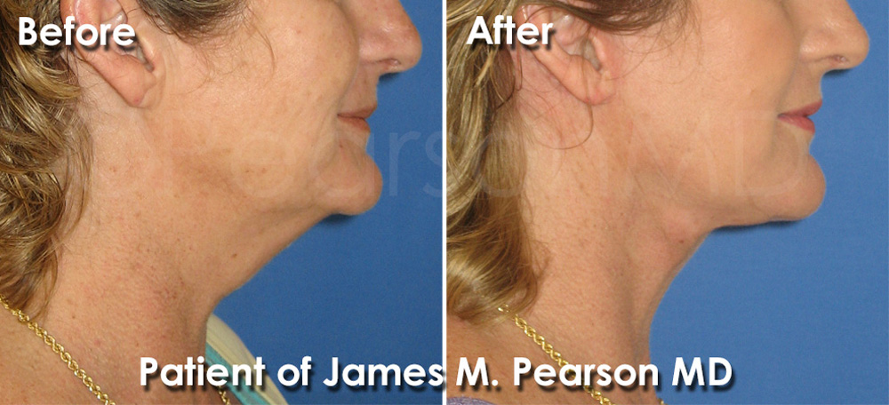Pearson Plastic Surgery