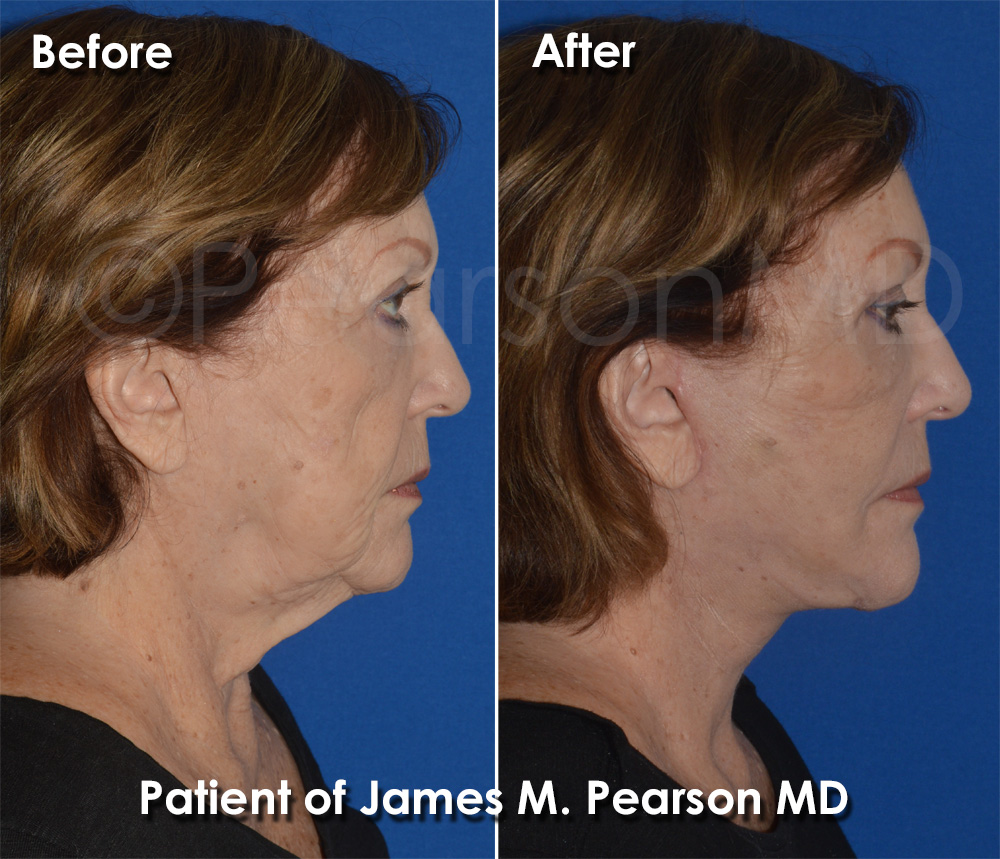Dr. Pearson Facelift