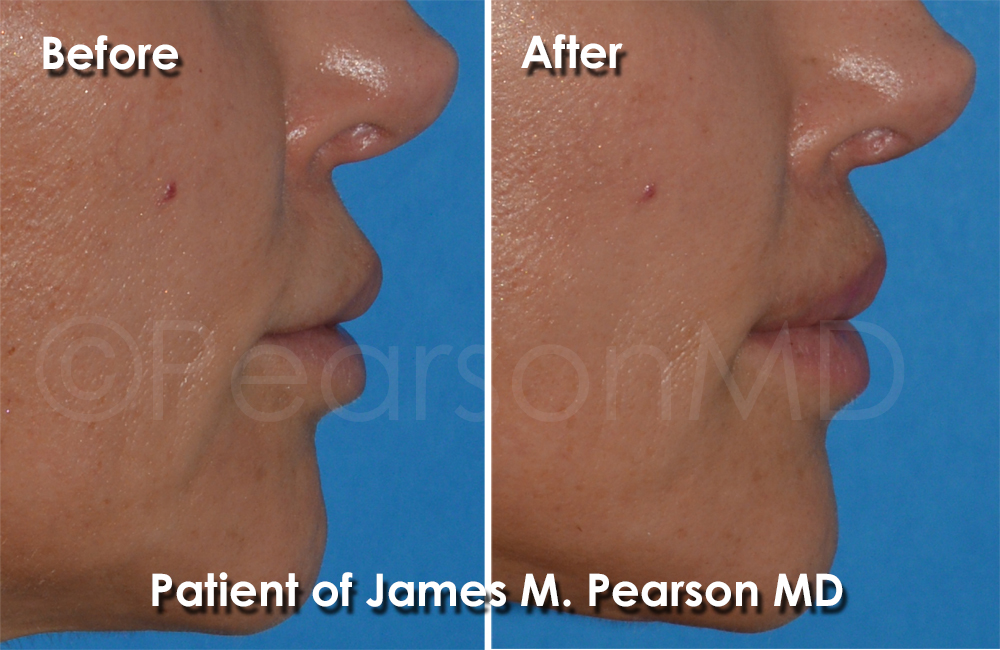 Pearson Plastic Surgery