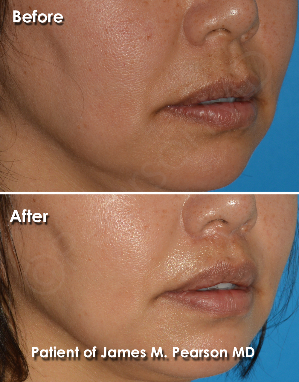 Dr. Pearson Facial Plastic Surgeon