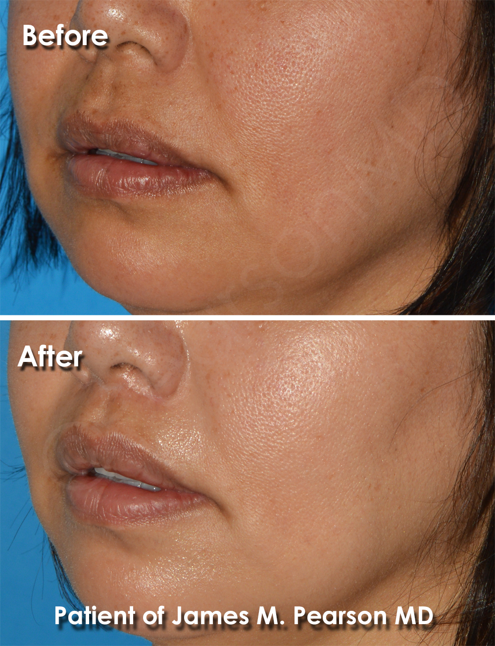 Dr. Pearson Facial Plastic Surgeon