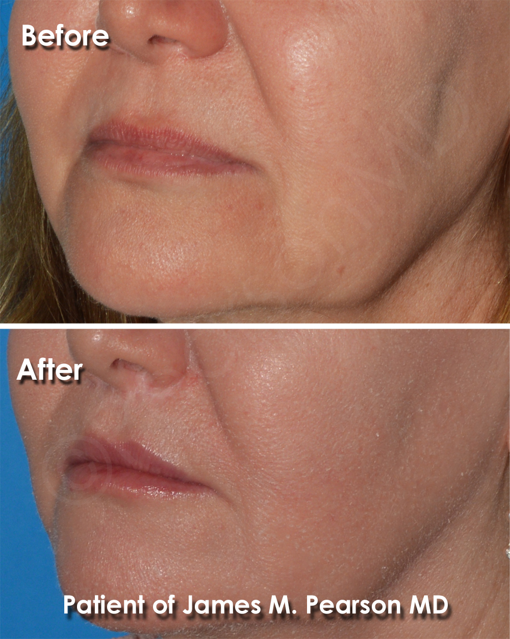 Dr. Pearson Facial Plastic Surgeon
