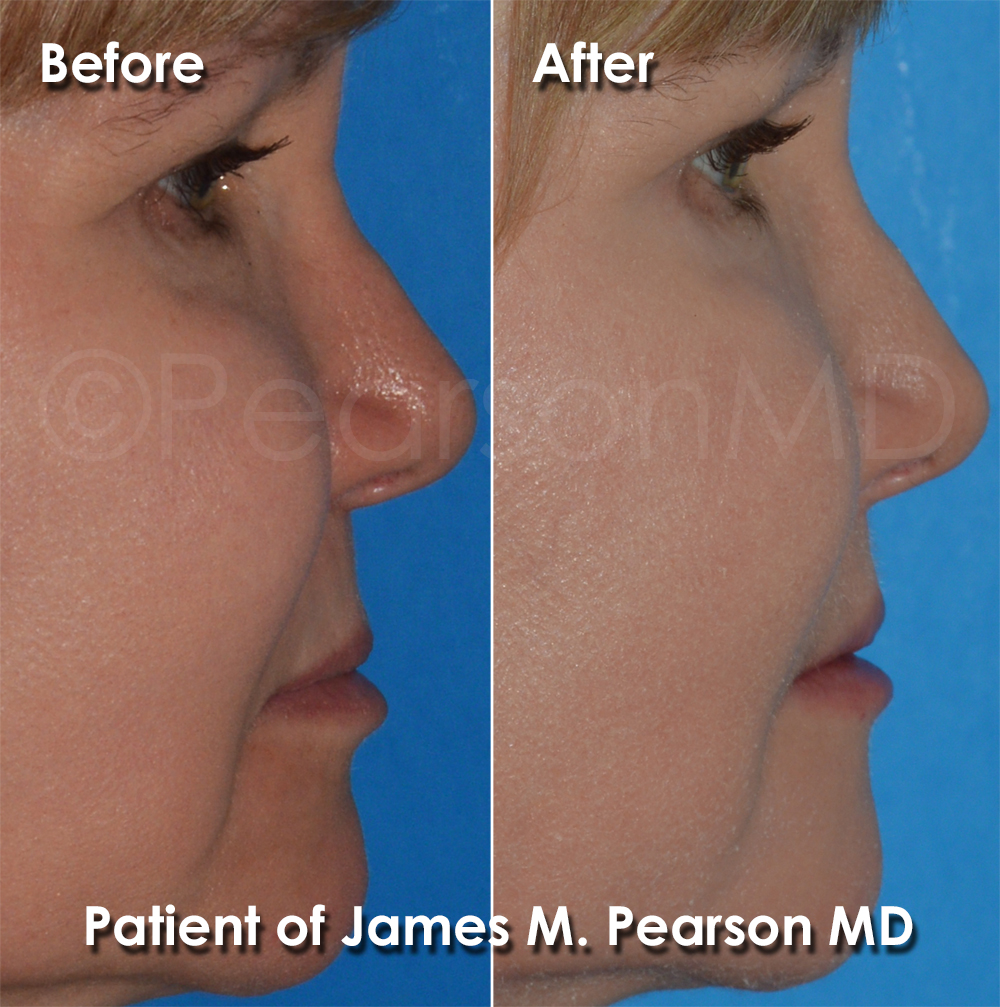 Dr. Pearson Facial Plastic Surgeon