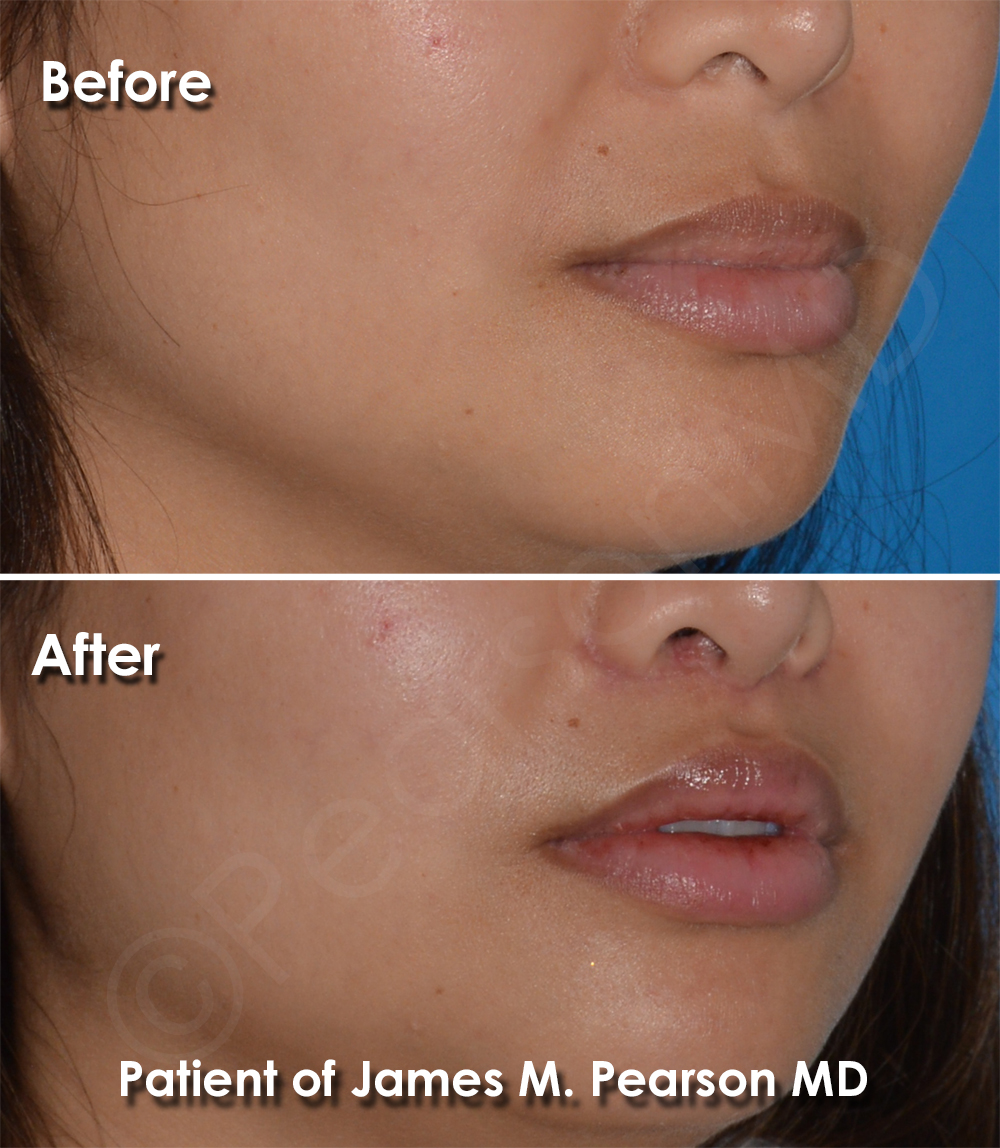 Dr. Pearson Facial Plastic Surgeon