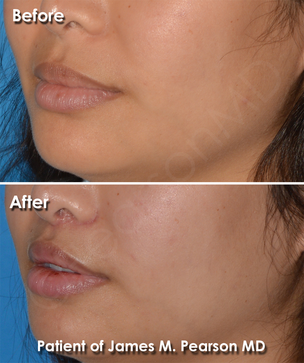 Dr. Pearson Facial Plastic Surgeon
