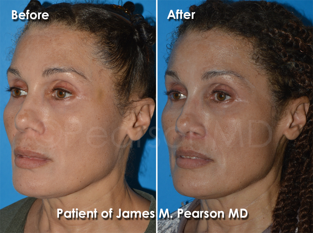 Pearson Plastic Surgery