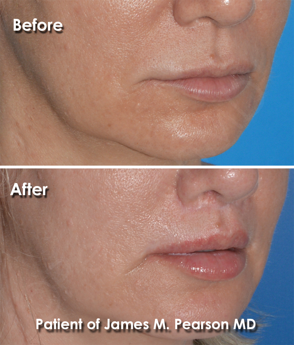 Dr. Pearson Facial Plastic Surgeon