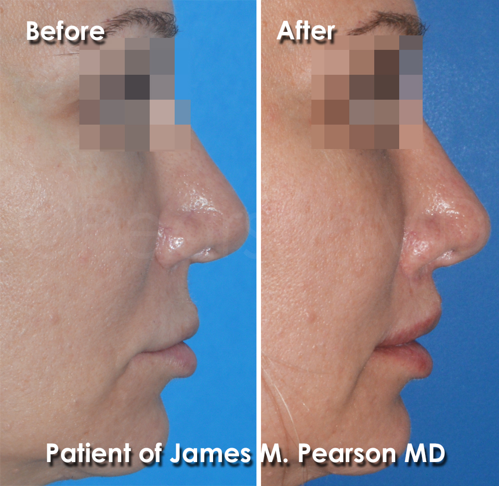 Dr. Pearson Facial Plastic Surgeon