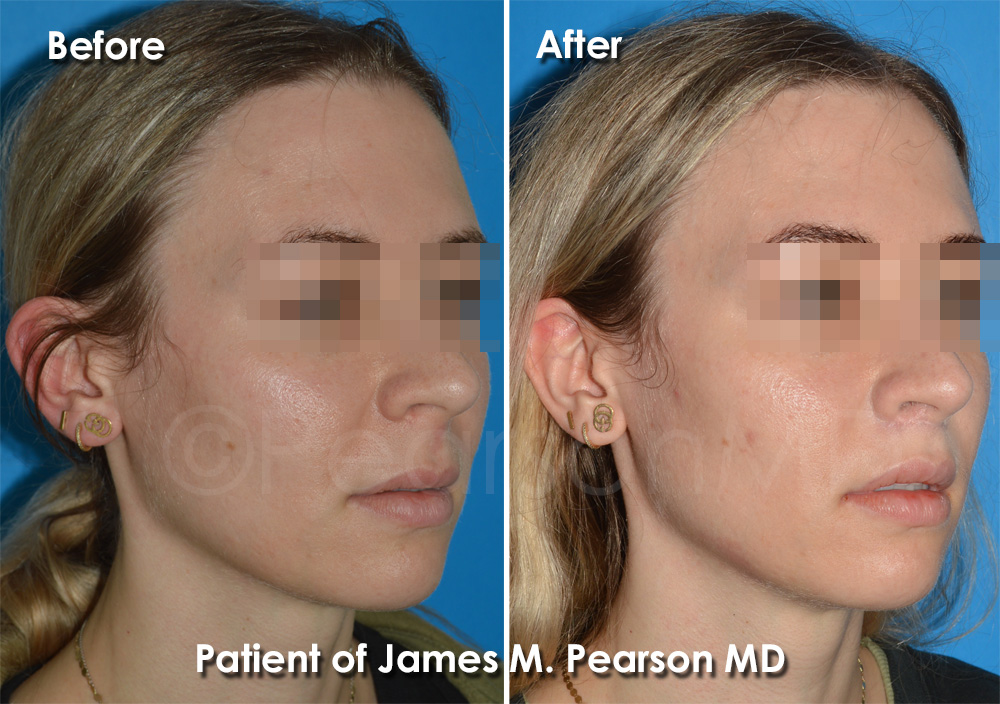 Dr. Pearson Facial Plastic Surgeon