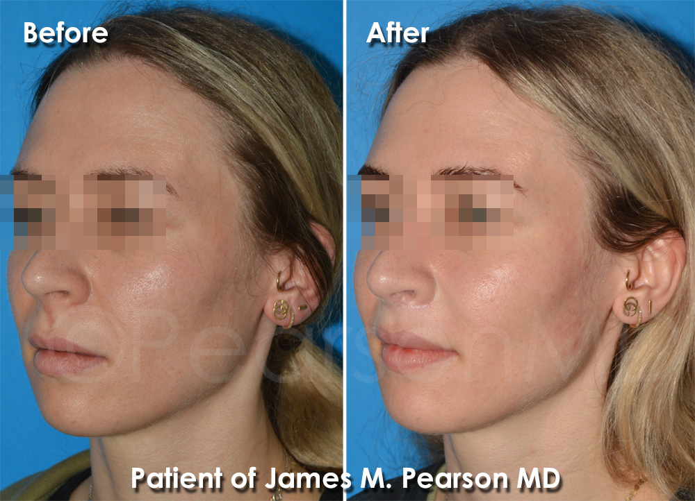 Dr. Pearson Facial Plastic Surgeon