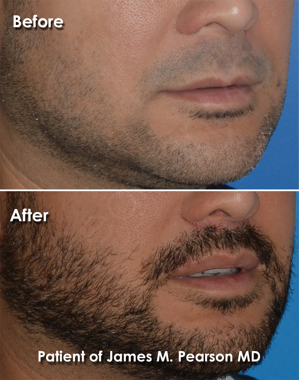 Dr. Pearson Facial Plastic Surgeon