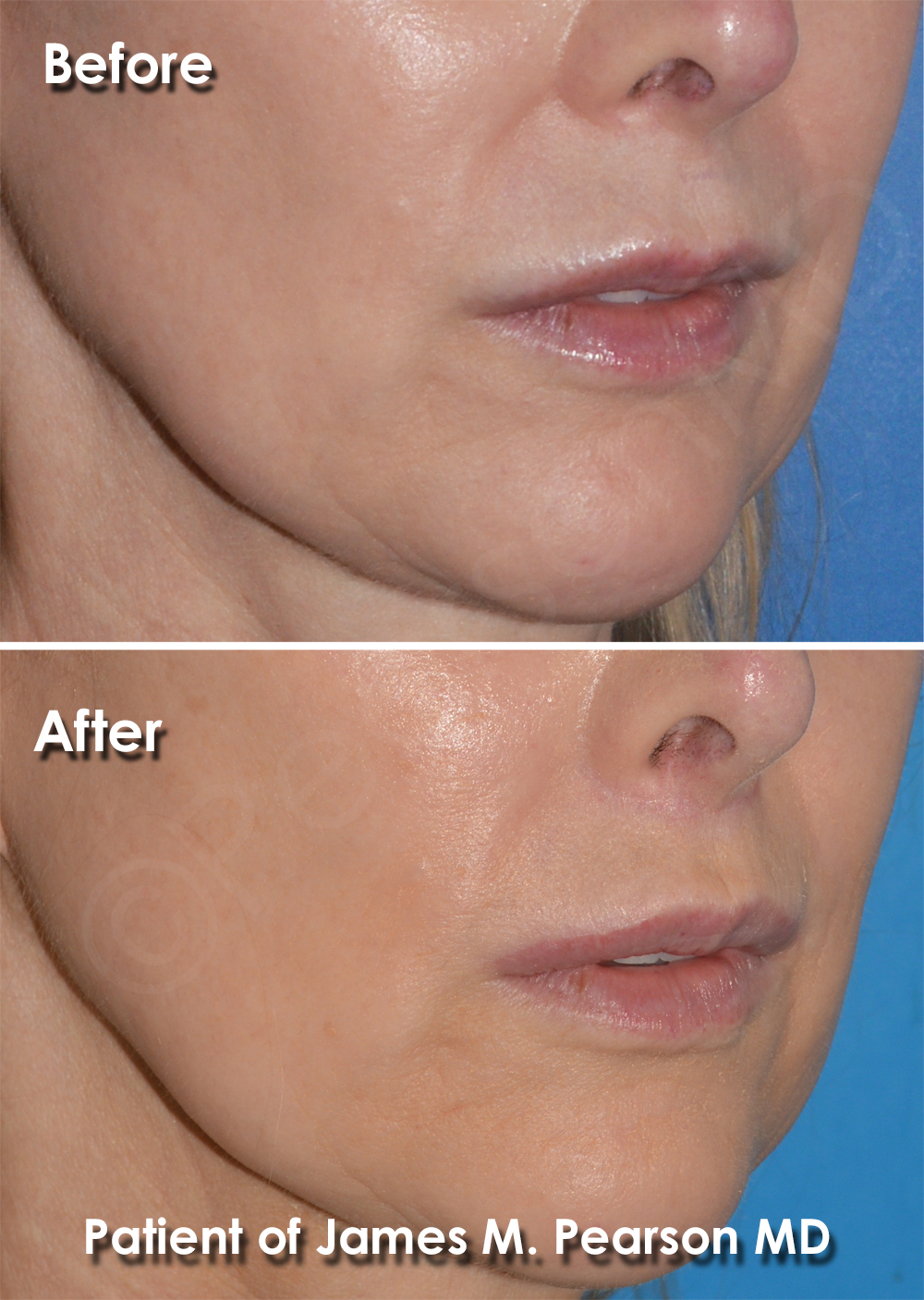 Dr. Pearson Facial Plastic Surgeon