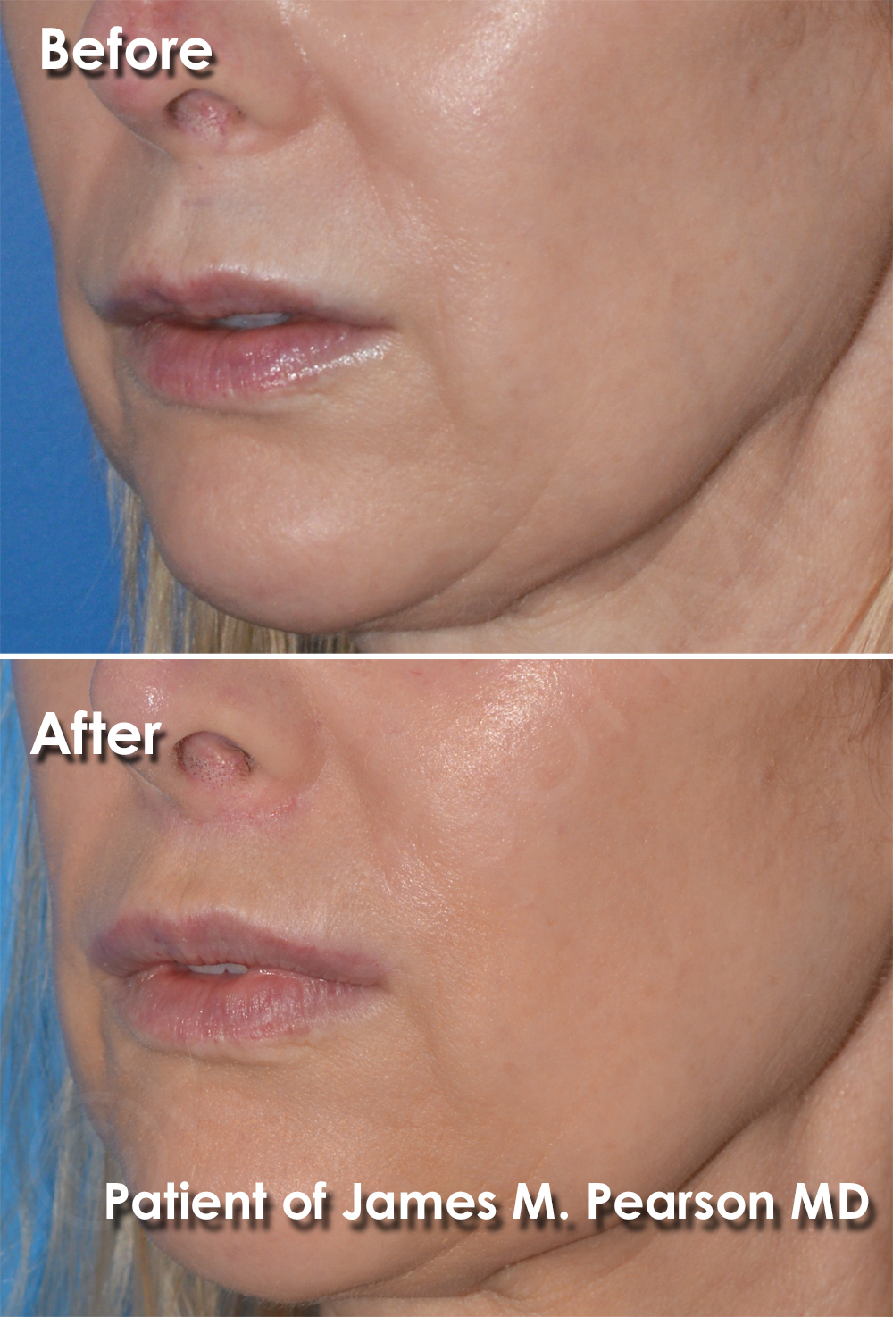 Dr. Pearson Facial Plastic Surgeon