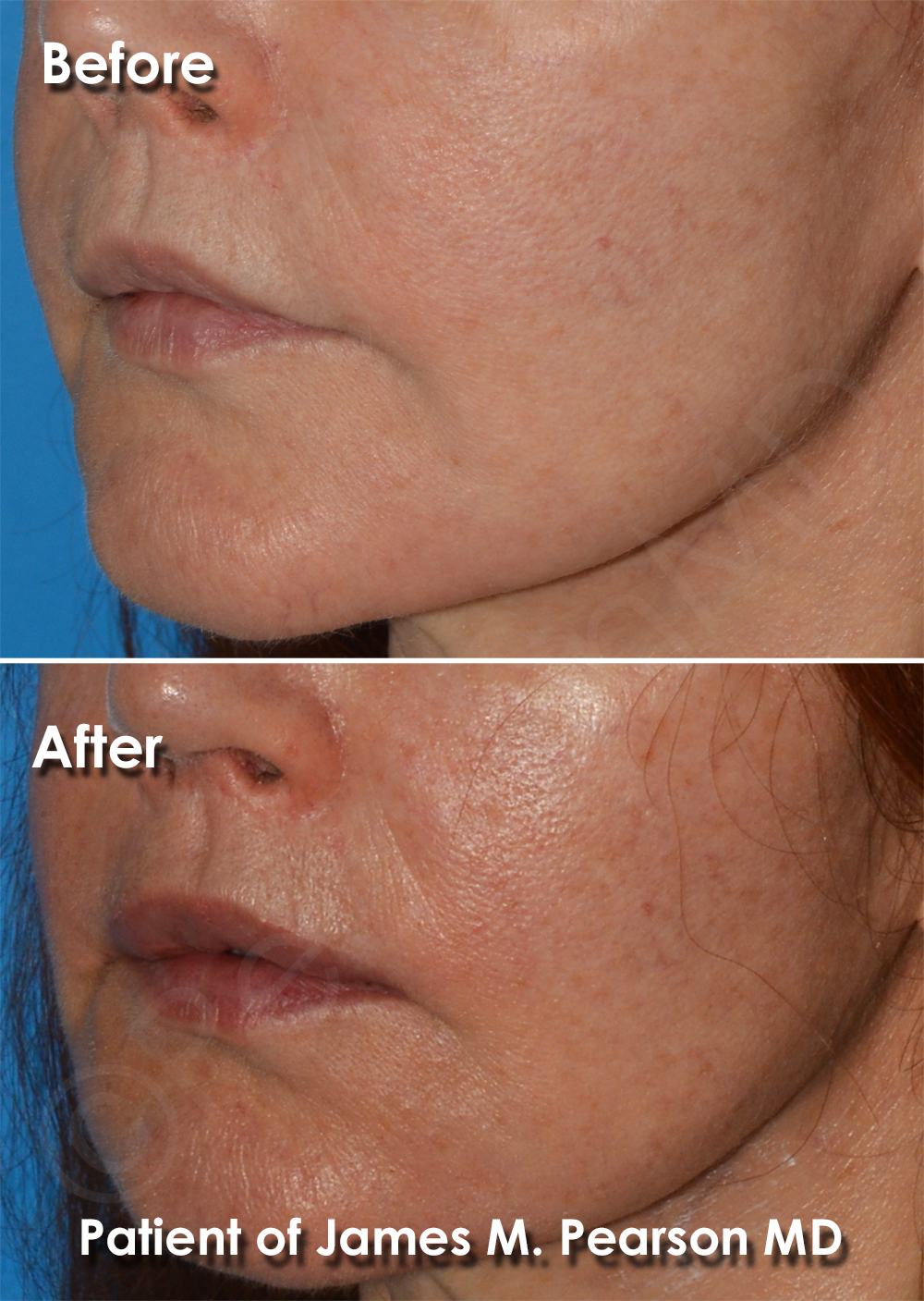 Dr. Pearson Facial Plastic Surgeon