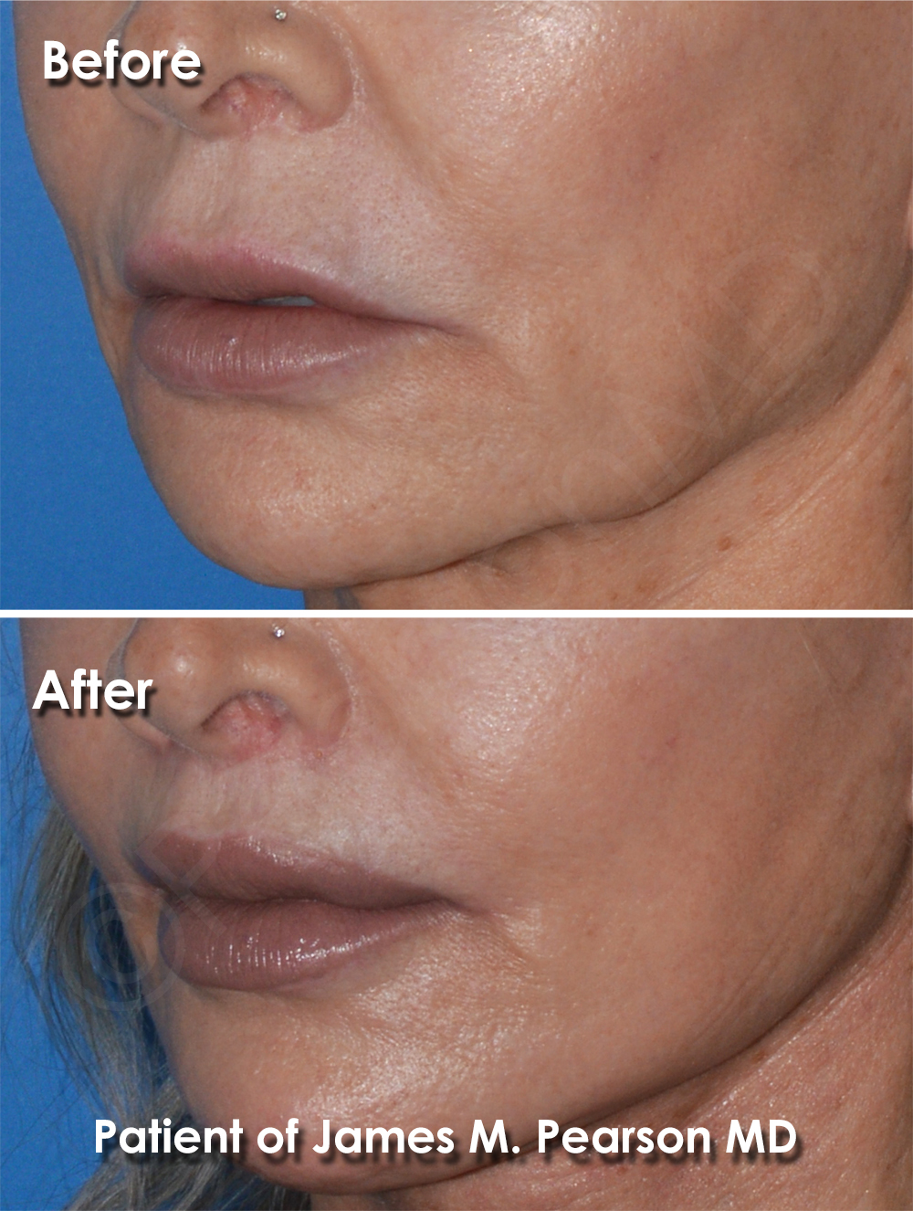 Dr. Pearson Facial Plastic Surgeon
