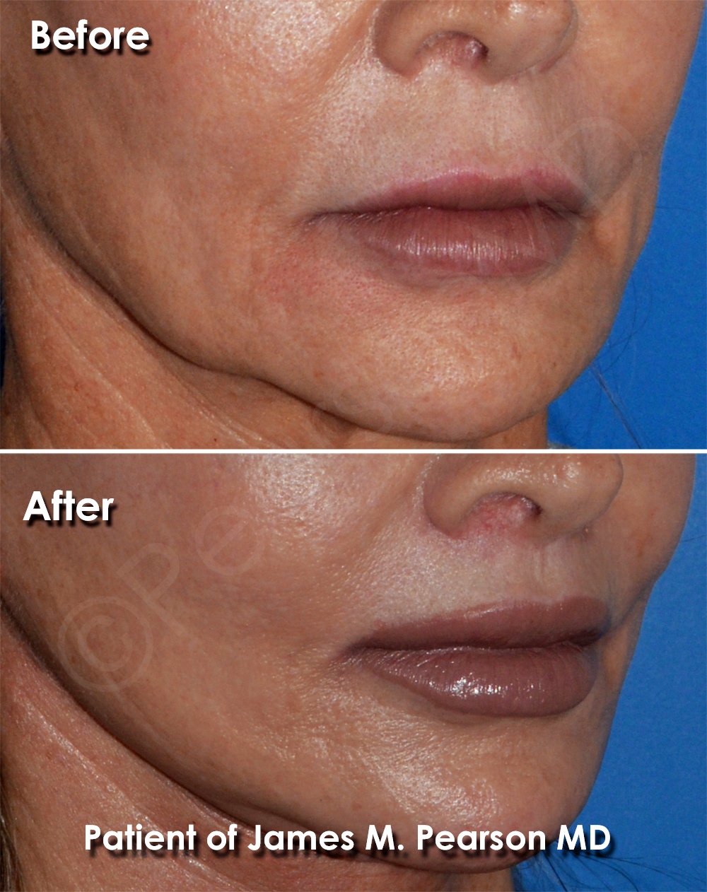 Pearson Plastic Surgery