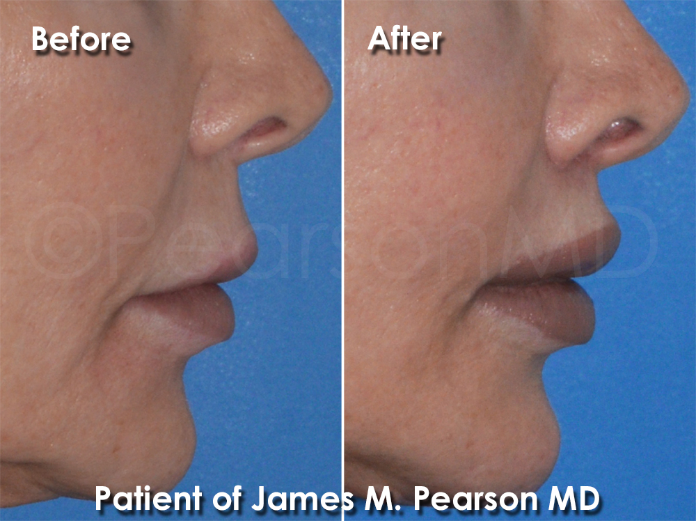 Pearson Plastic Surgery