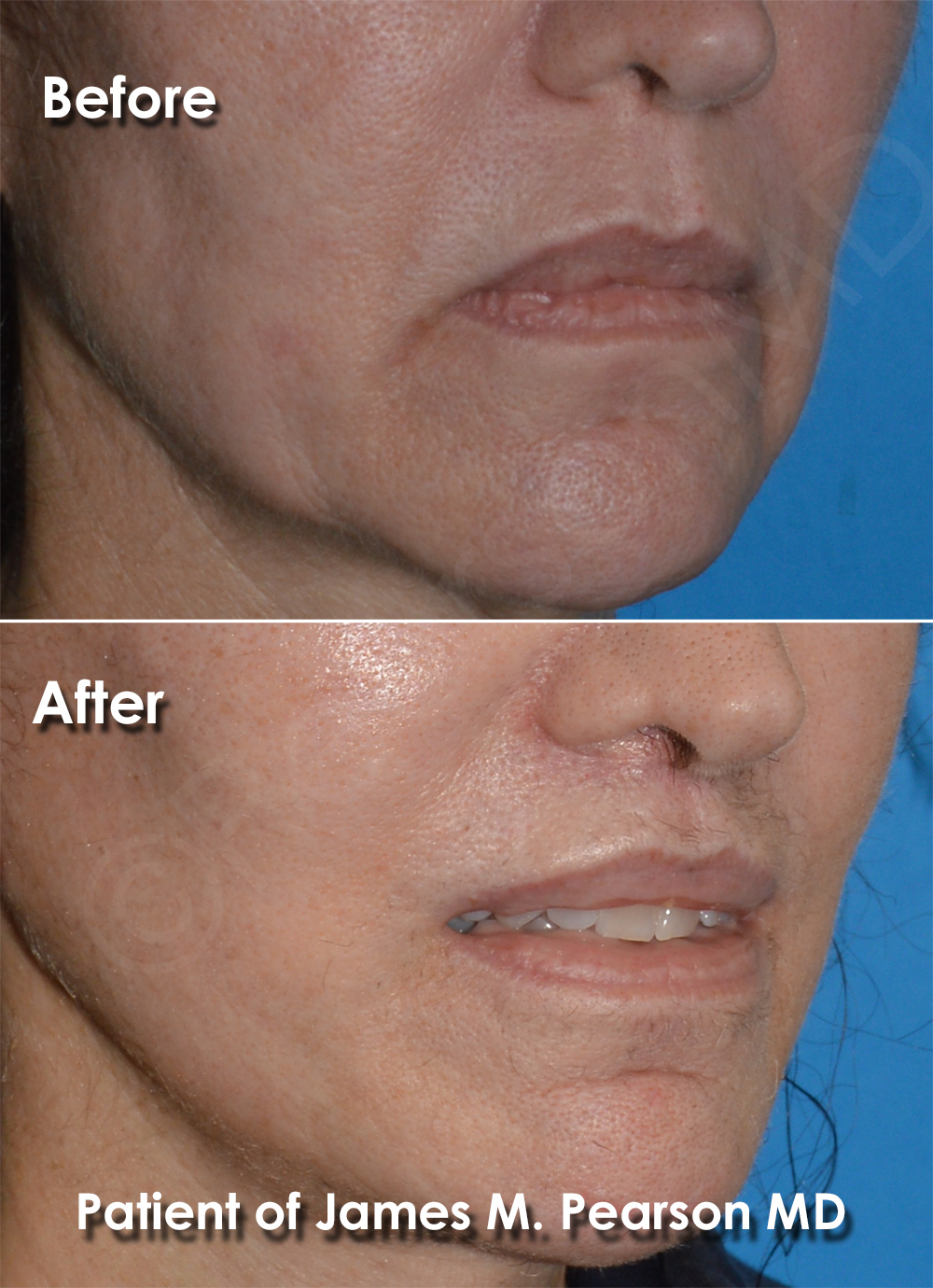 Dr. Pearson Facial Plastic Surgeon