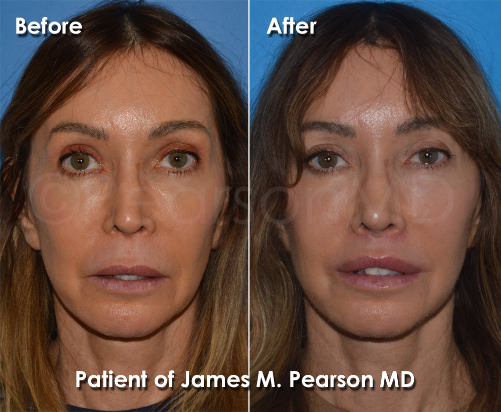 Dr. Pearson Facial Plastic Surgeon