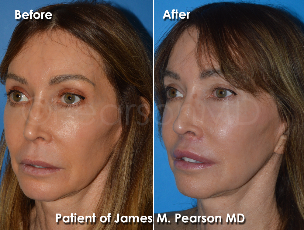 Dr. Pearson Facial Plastic Surgeon