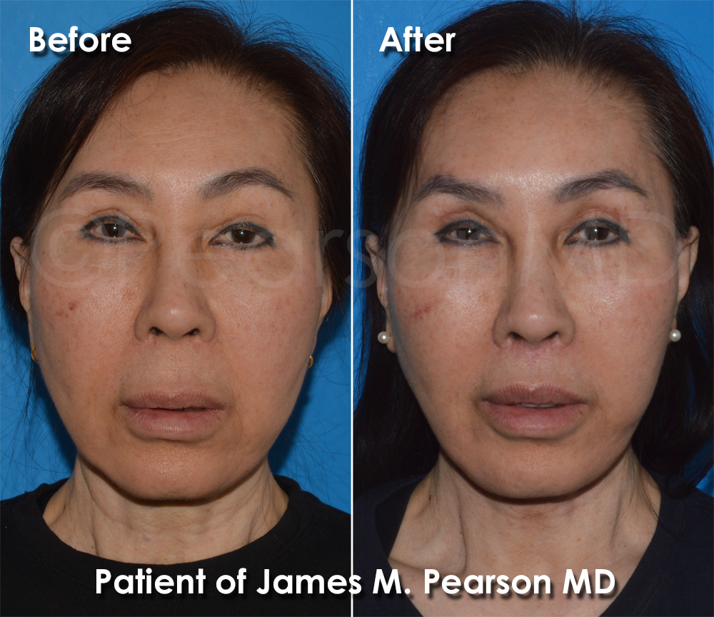 Dr. Pearson Facial Plastic Surgeon