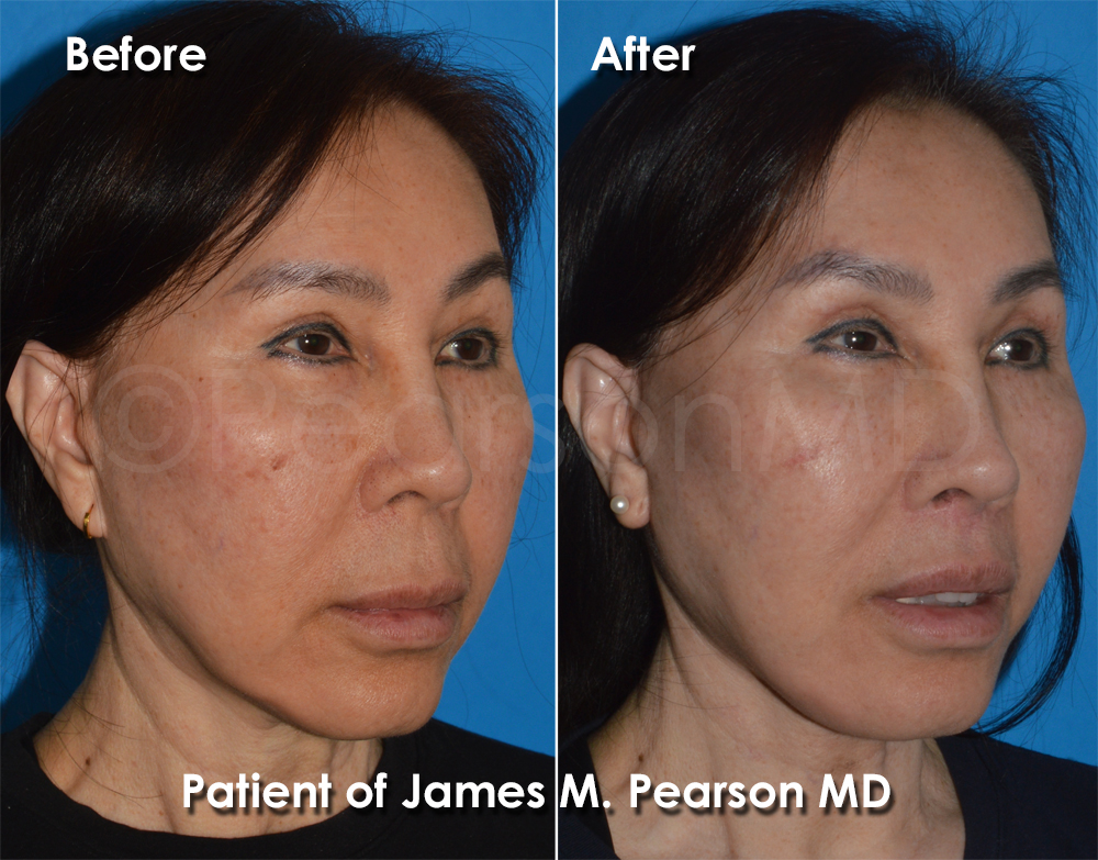 Dr. Pearson Facial Plastic Surgeon