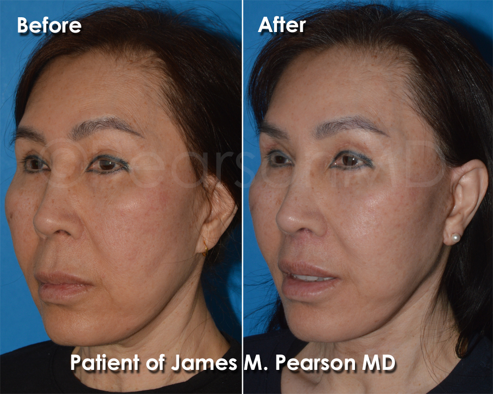 Dr. Pearson Facial Plastic Surgeon
