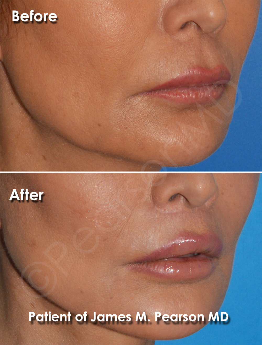 Dr. Pearson Facial Plastic Surgeon