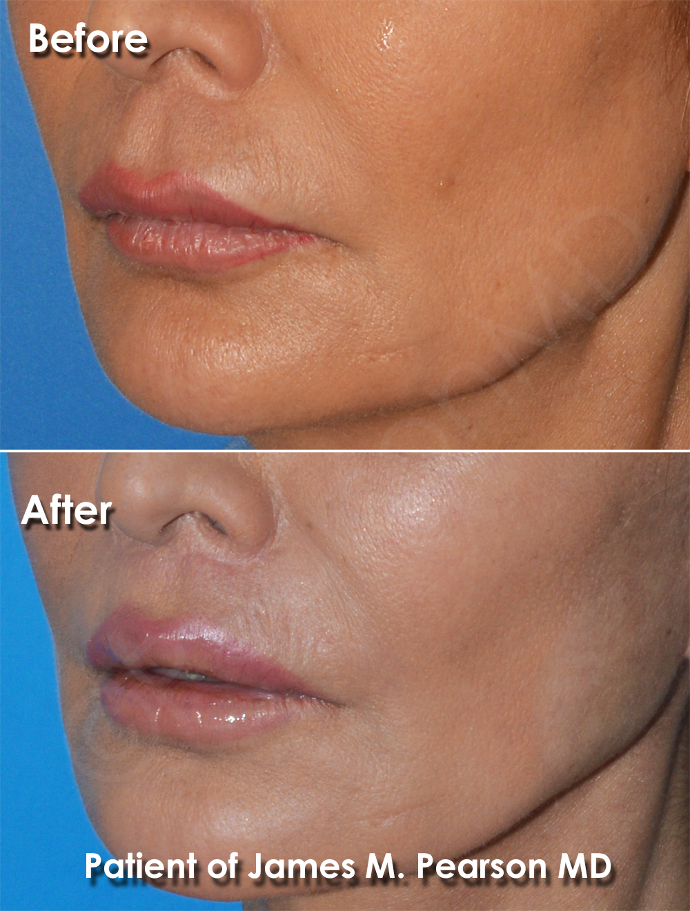 Dr. Pearson Facial Plastic Surgeon