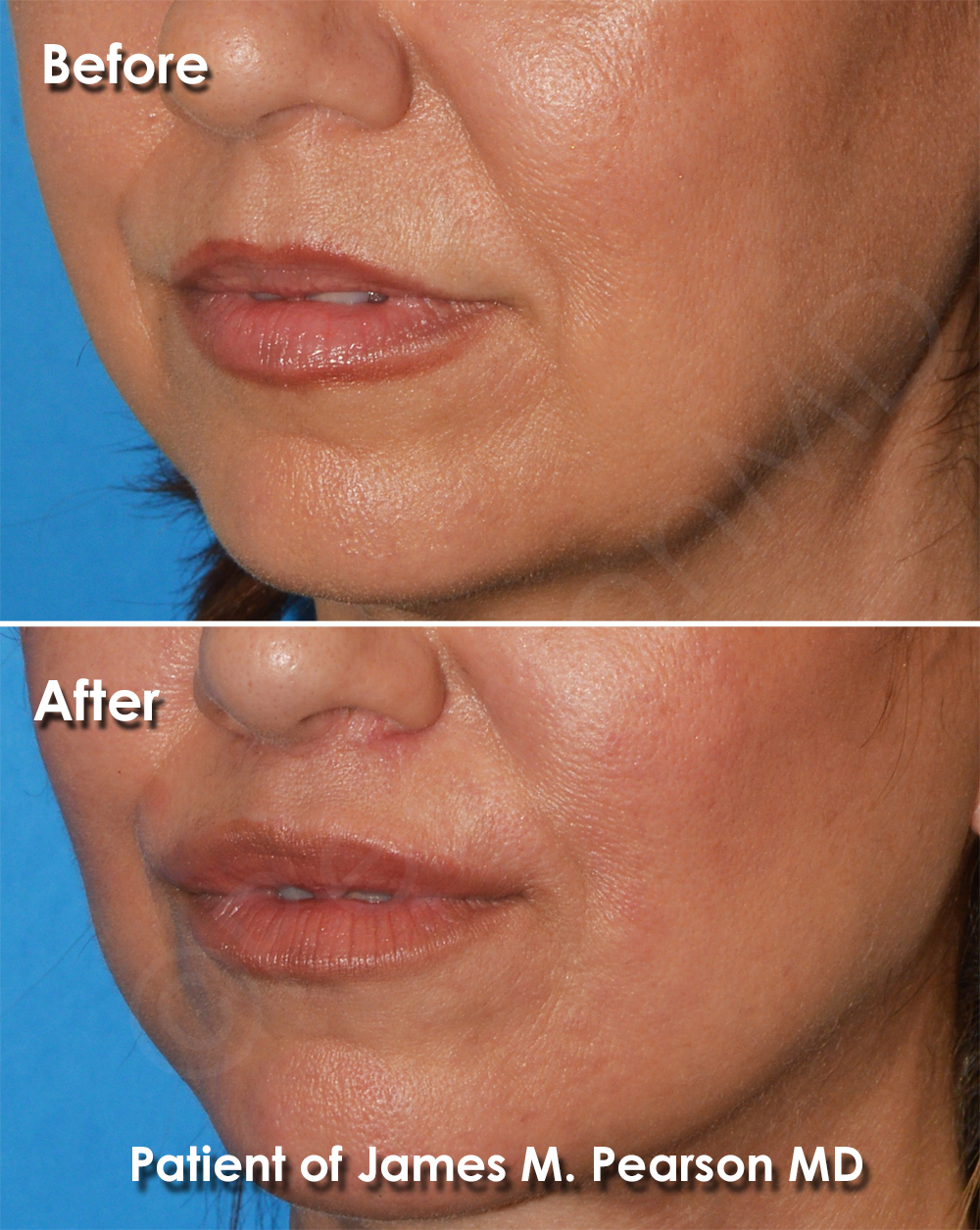 Dr. Pearson Facial Plastic Surgeon