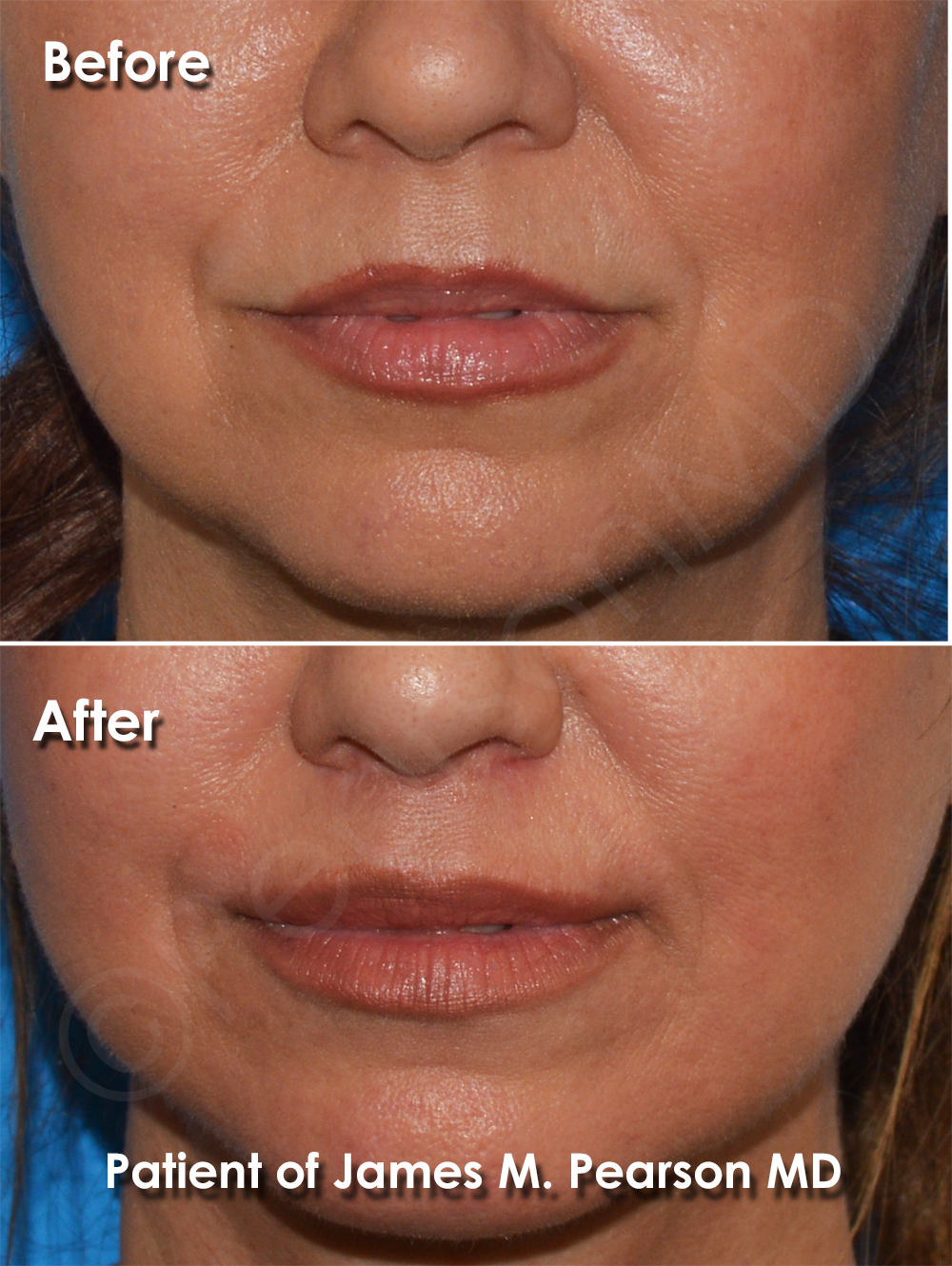 Dr. Pearson Facial Plastic Surgeon