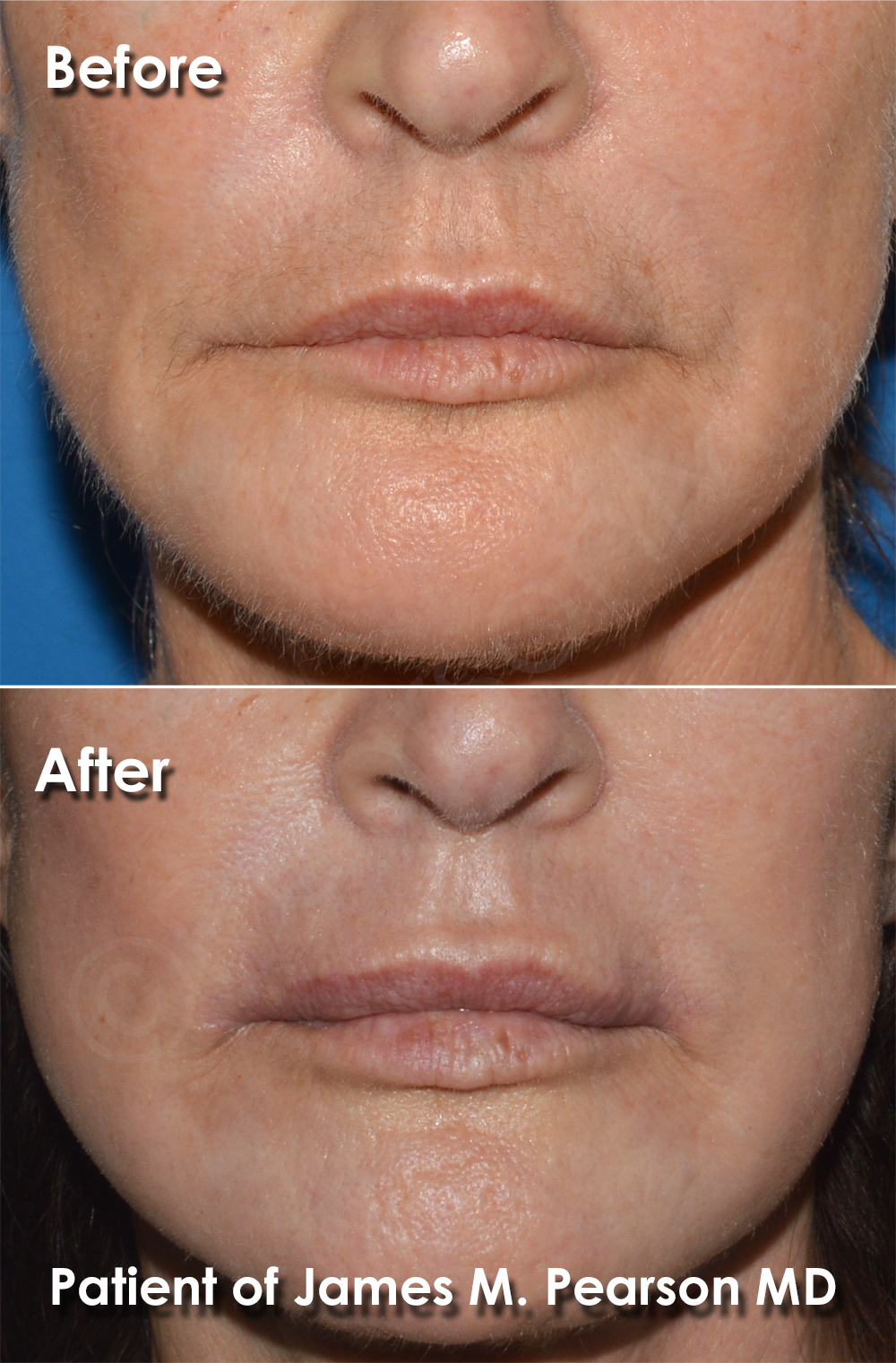 Dr. Pearson Facial Plastic Surgeon
