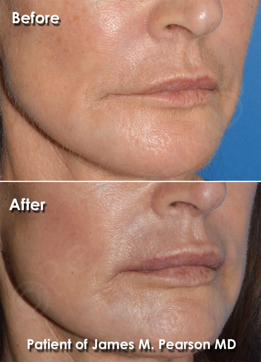 Dr. Pearson Facial Plastic Surgeon