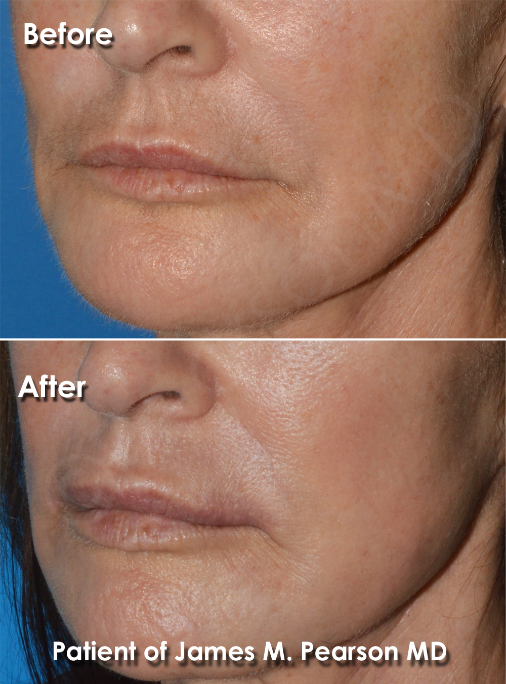 Dr. Pearson Facial Plastic Surgeon