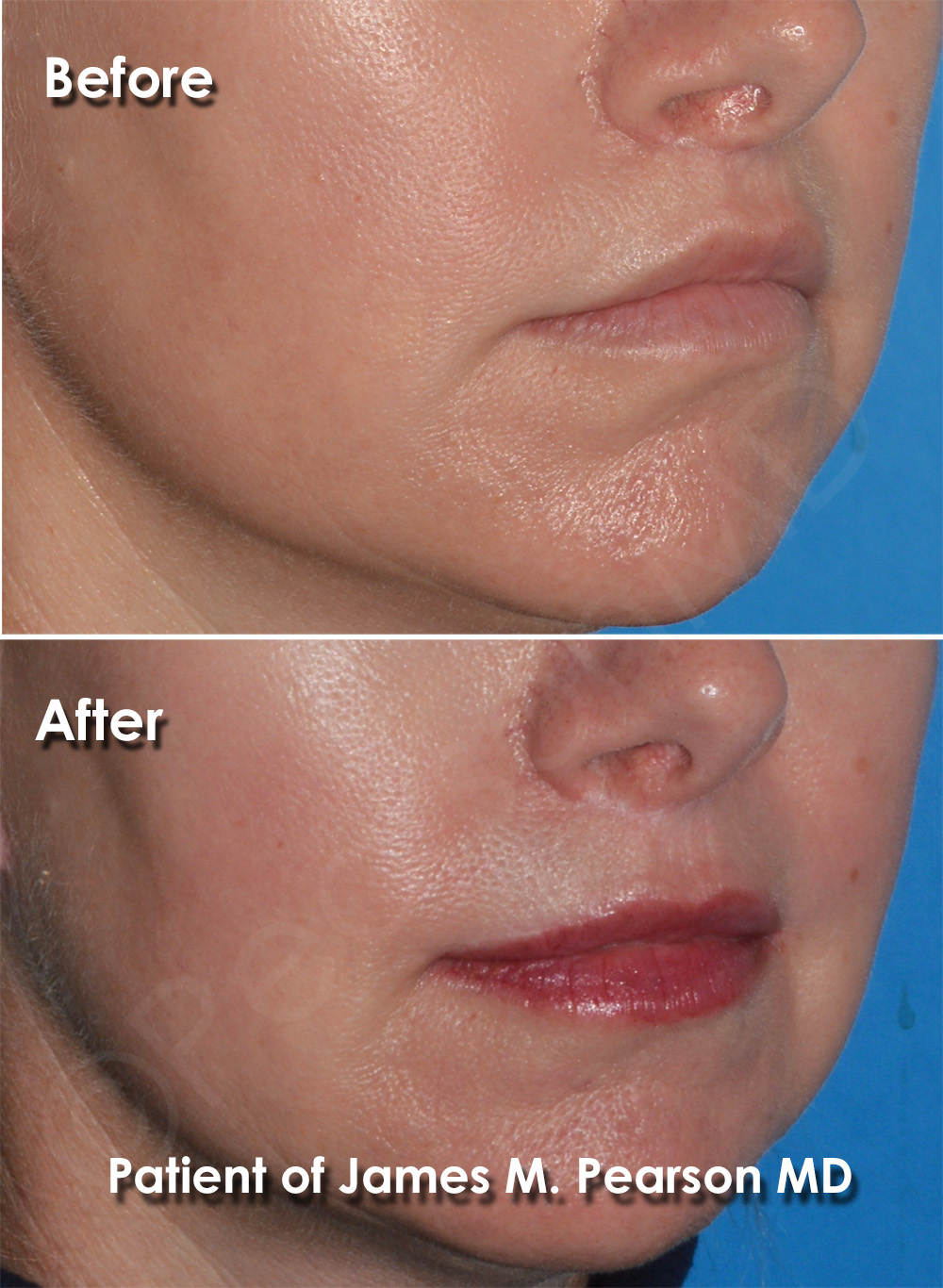 Dr. Pearson Facial Plastic Surgeon