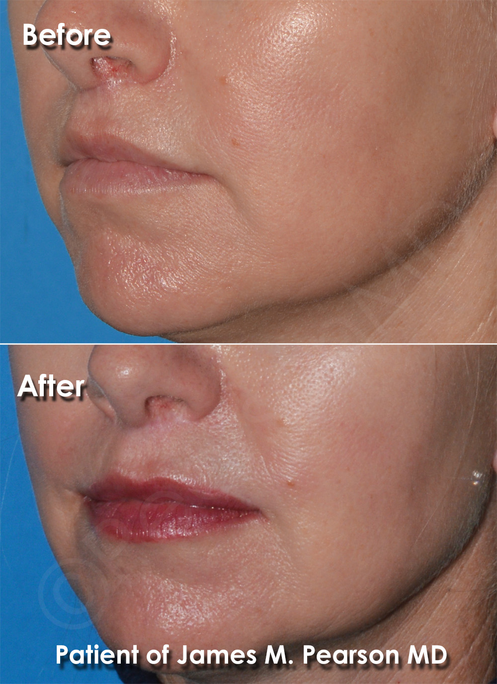 Dr. Pearson Facial Plastic Surgeon