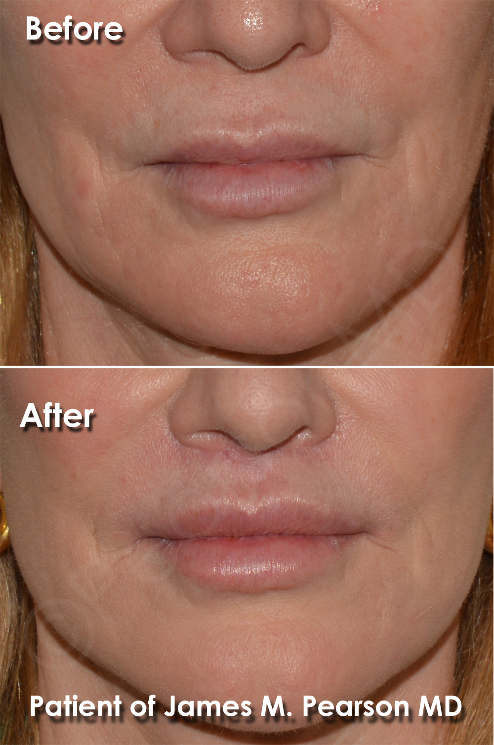Dr. Pearson Facial Plastic Surgeon