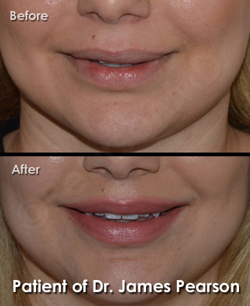 Photo Lip Lift by Dr. James Pearson Facial Plastic Surgery Pearson Lip Lift Photos