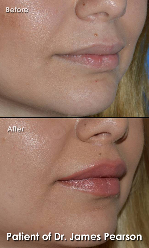 Photo Lip Lift by Dr. James Pearson Facial Plastic Surgery Pearson Lip Lift Photos