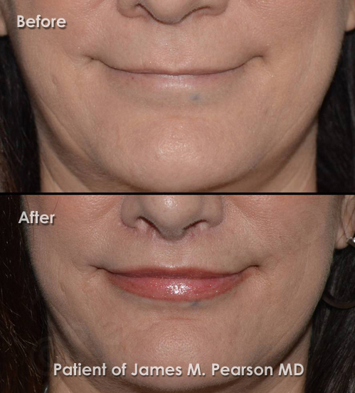 Beverly Hills Lip Lift Photos