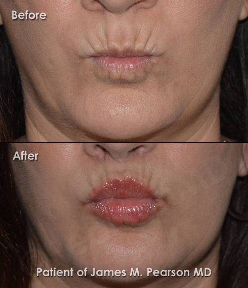 Pearson Lip Lift Photos